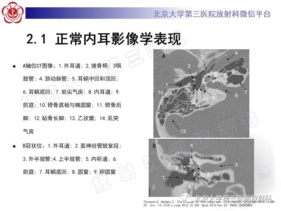 【PPT】内耳发育畸形-16