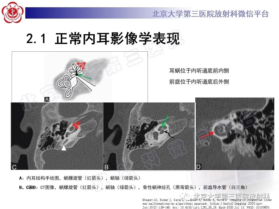 【PPT】内耳发育畸形-17