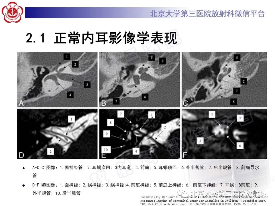 【PPT】内耳发育畸形-18