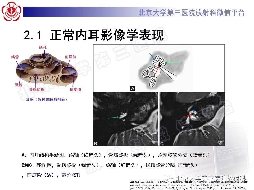 【PPT】内耳发育畸形-19