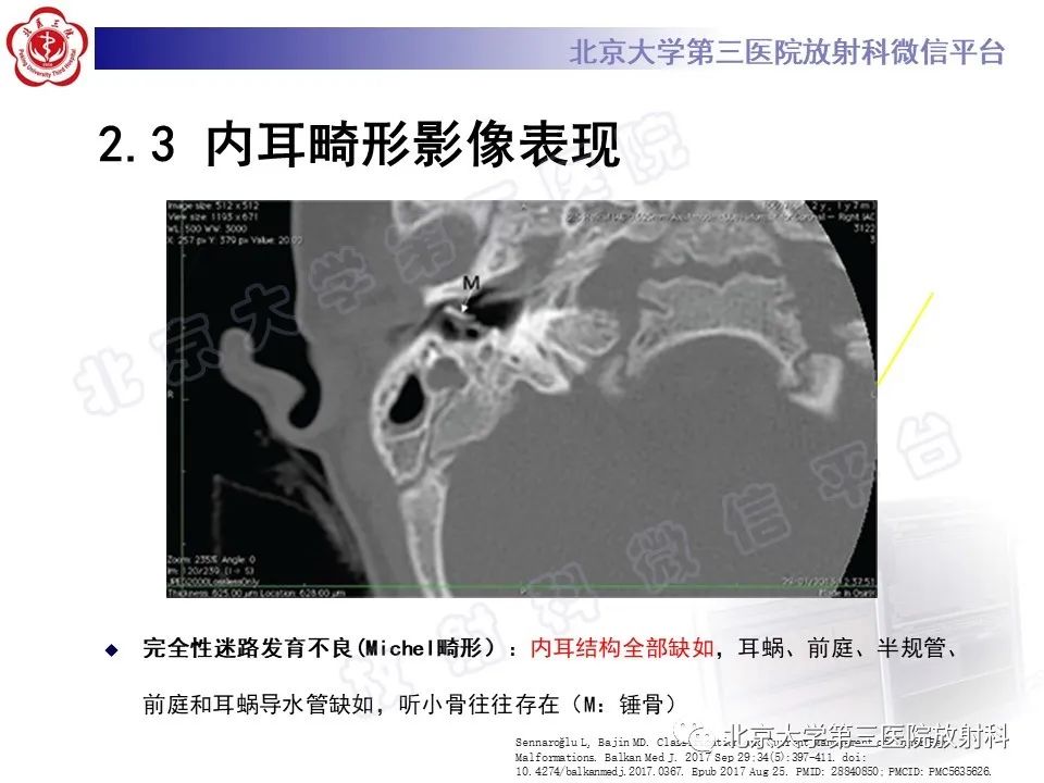 【PPT】内耳发育畸形-22