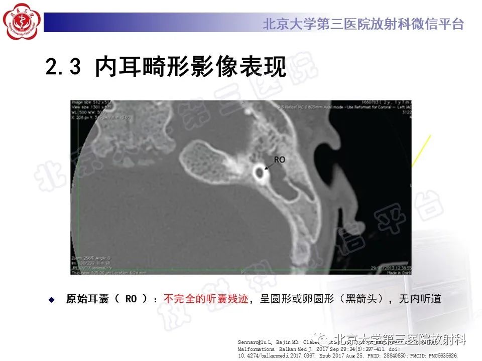 【PPT】内耳发育畸形-23