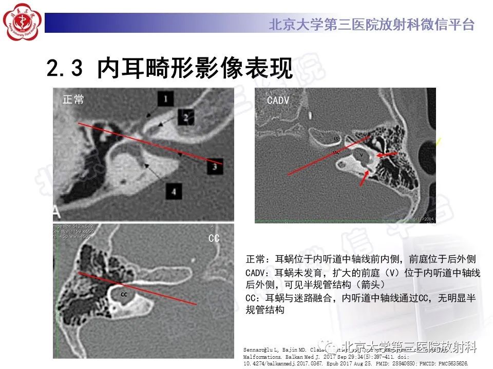 【PPT】内耳发育畸形-26