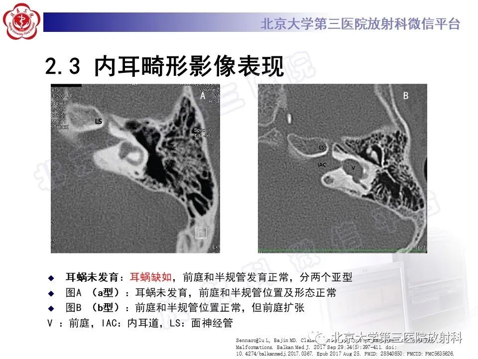 【PPT】内耳发育畸形-24