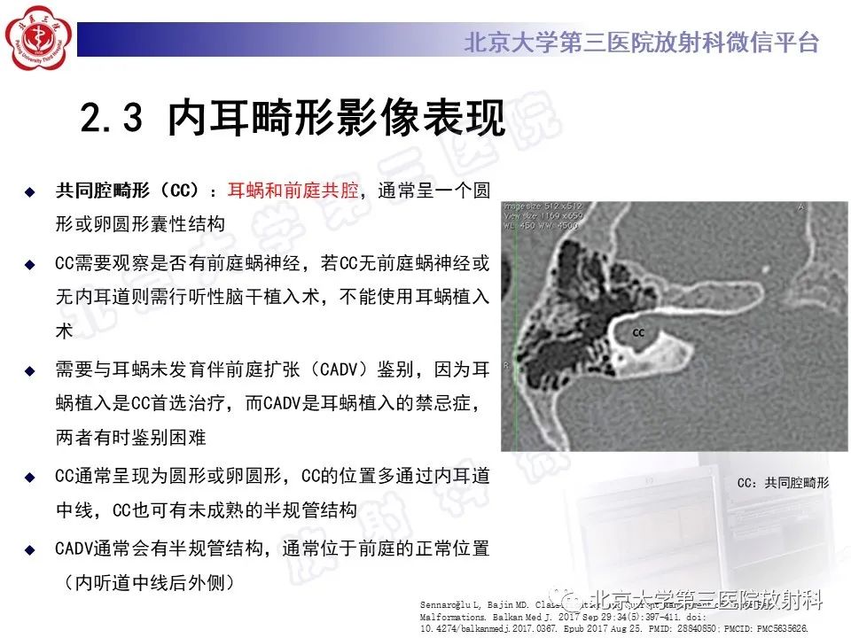 【PPT】内耳发育畸形-25