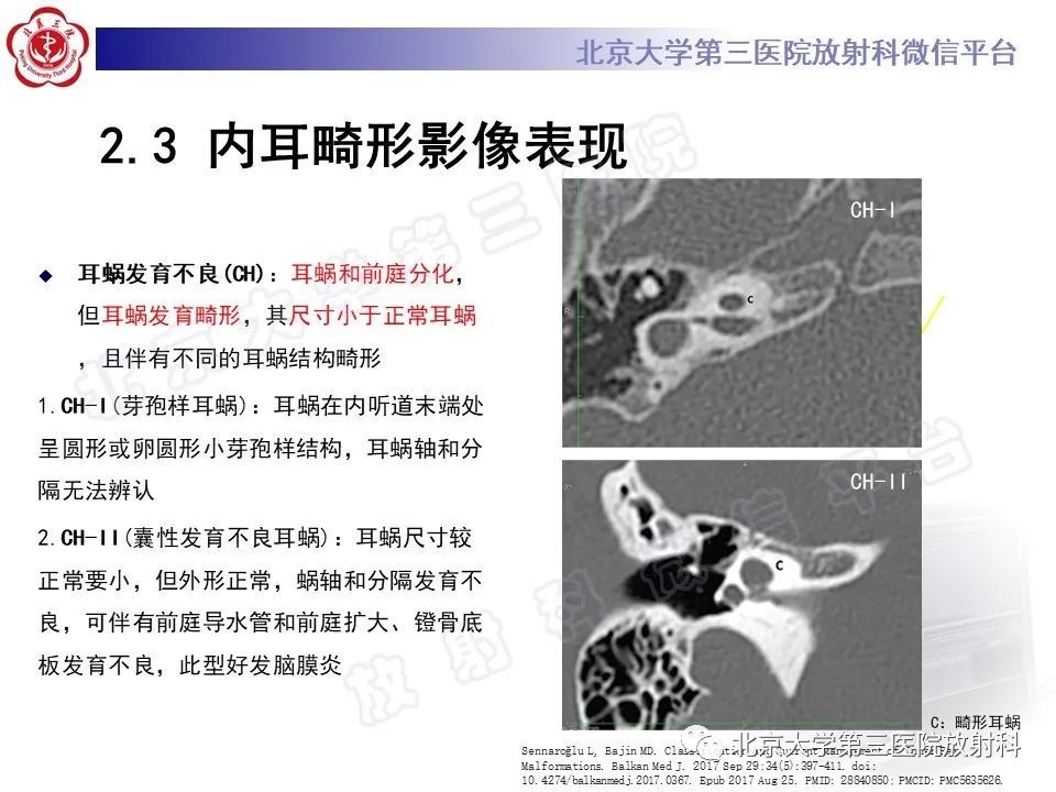 【PPT】内耳发育畸形-27