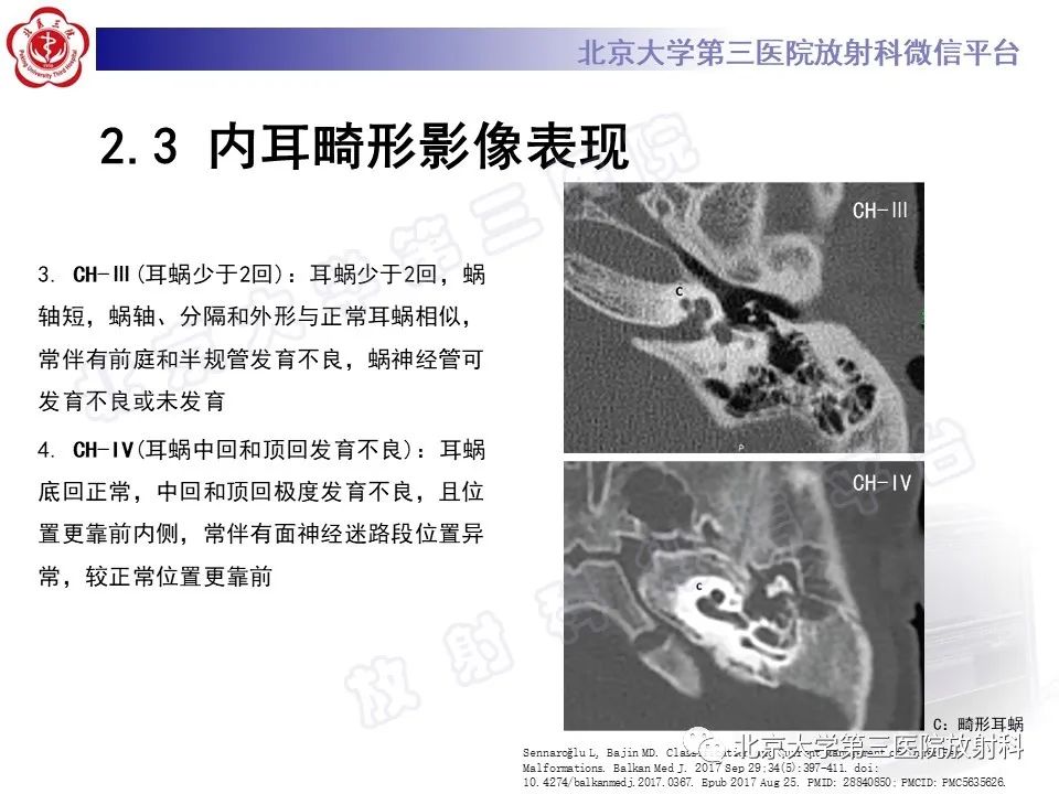 【PPT】内耳发育畸形-28