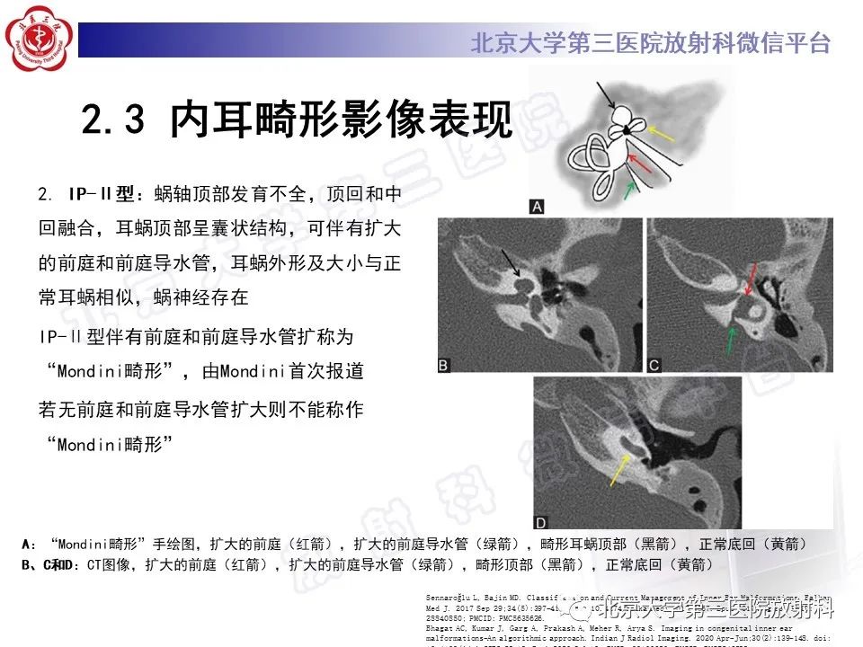 【PPT】内耳发育畸形-30