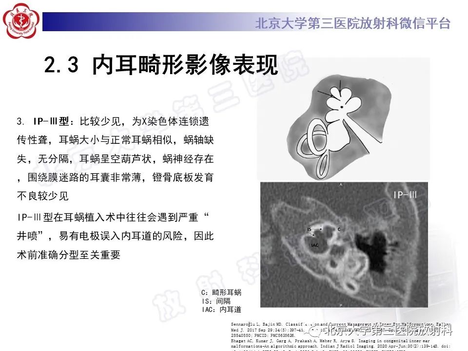 【PPT】内耳发育畸形-31