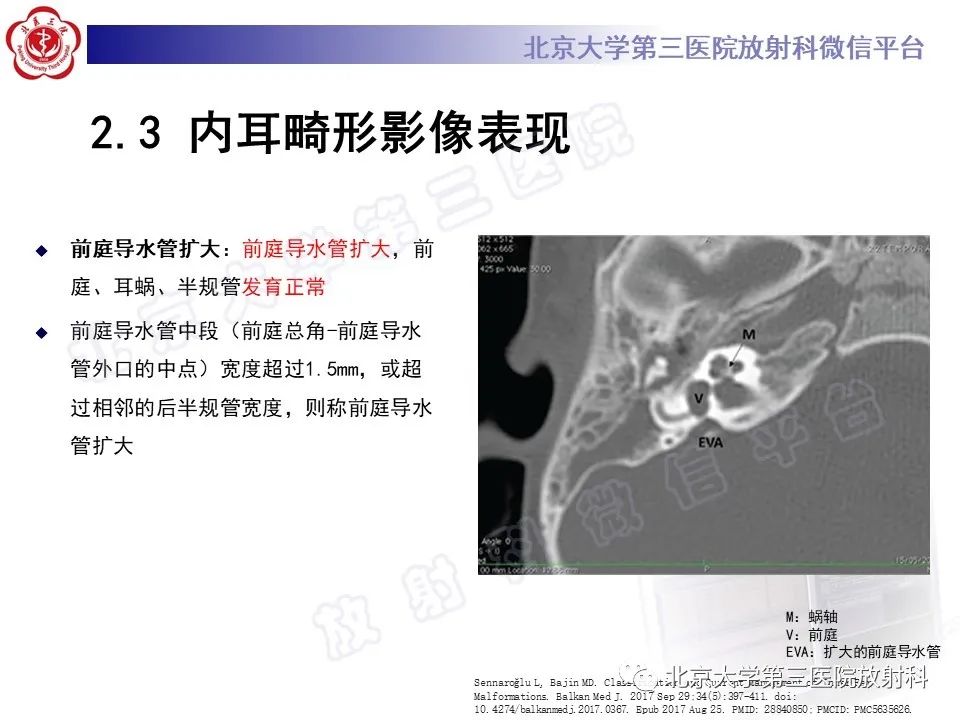 【PPT】内耳发育畸形-32