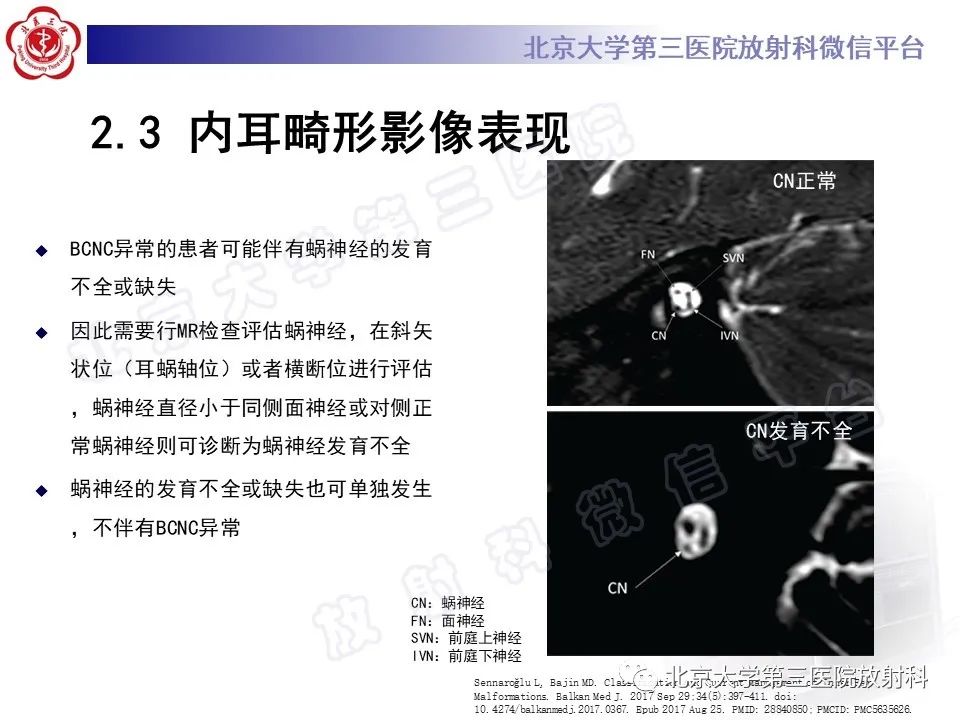 【PPT】内耳发育畸形-34
