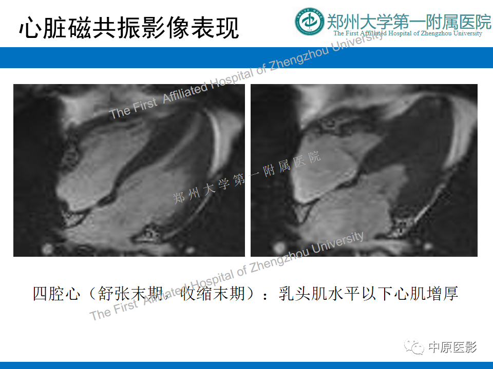 【病例】心尖肥厚型心肌病1例MR影像-3
