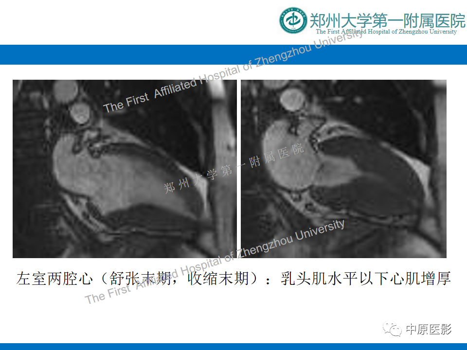 【病例】心尖肥厚型心肌病1例MR影像-4