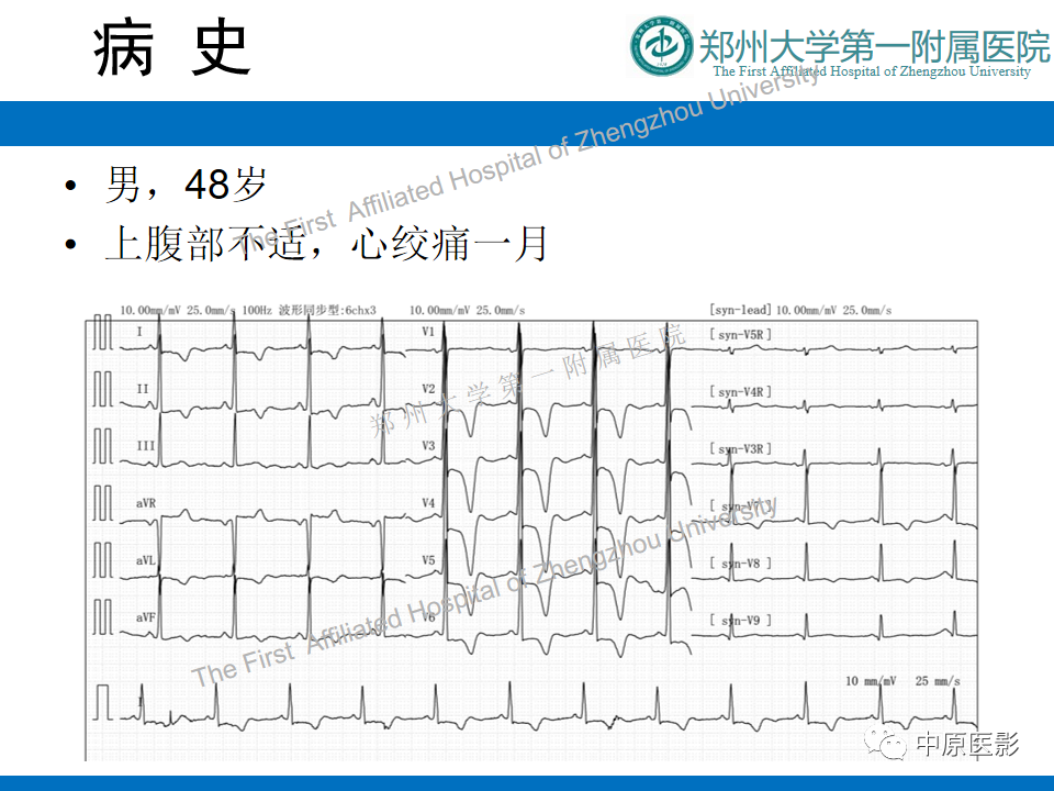 【病例】心尖肥厚型心肌病1例MR影像-2