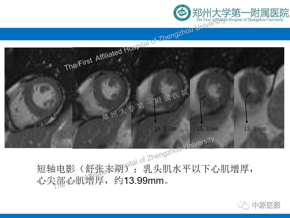 【病例】心尖肥厚型心肌病1例MR影像-5