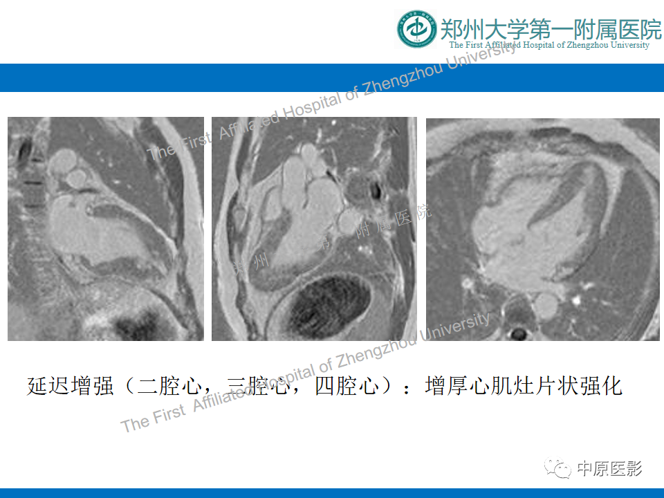 【病例】心尖肥厚型心肌病1例MR影像-6