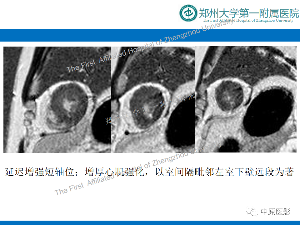 【病例】心尖肥厚型心肌病1例MR影像-7