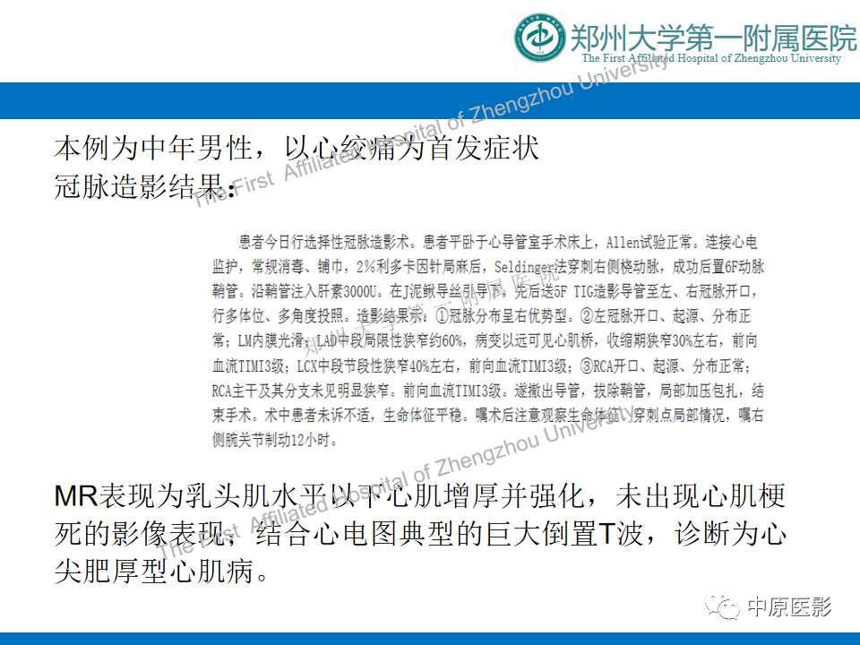 【病例】心尖肥厚型心肌病1例MR影像-9