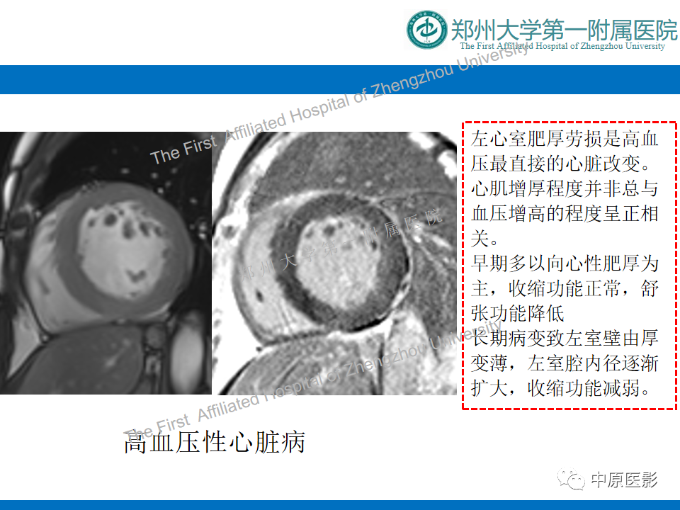 【病例】心尖肥厚型心肌病1例MR影像-14