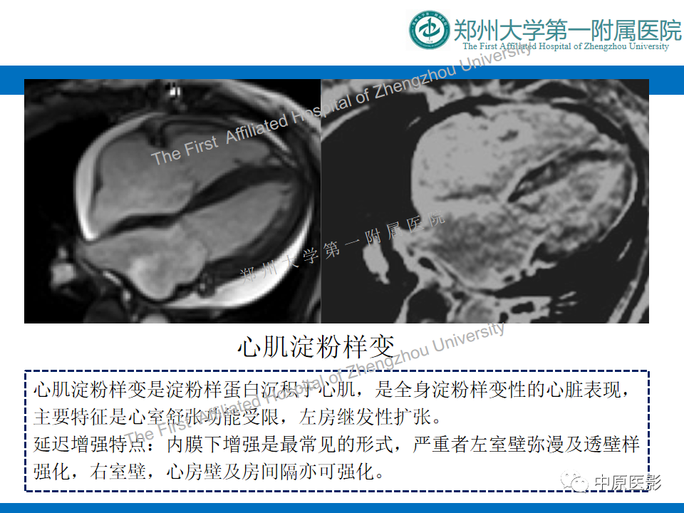 【病例】心尖肥厚型心肌病1例MR影像-15