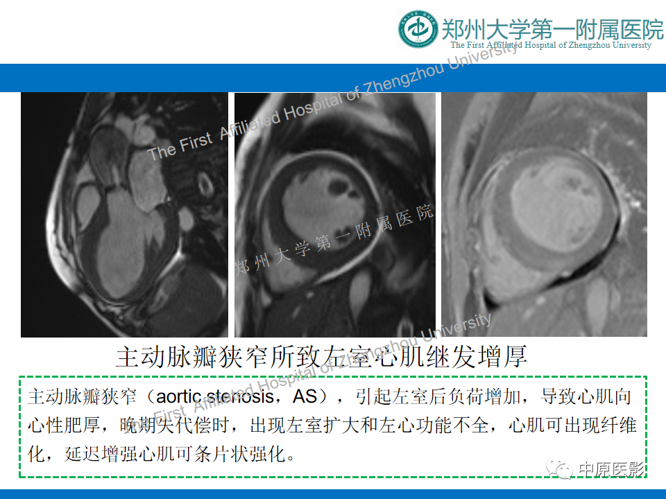 【病例】心尖肥厚型心肌病1例MR影像-16