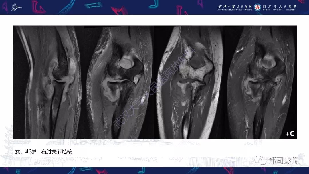 【PPT】关节滑膜弥漫性增厚病变影像诊断-7