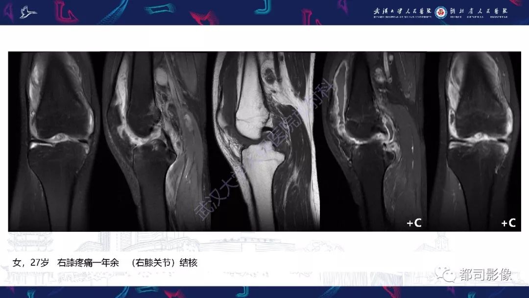 【PPT】关节滑膜弥漫性增厚病变影像诊断-6