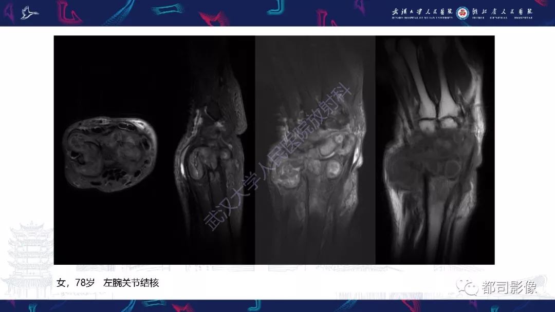 【PPT】关节滑膜弥漫性增厚病变影像诊断-8