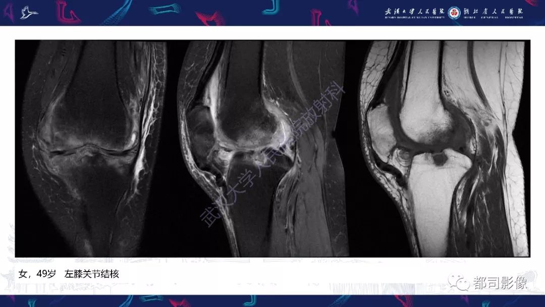 【PPT】关节滑膜弥漫性增厚病变影像诊断-9