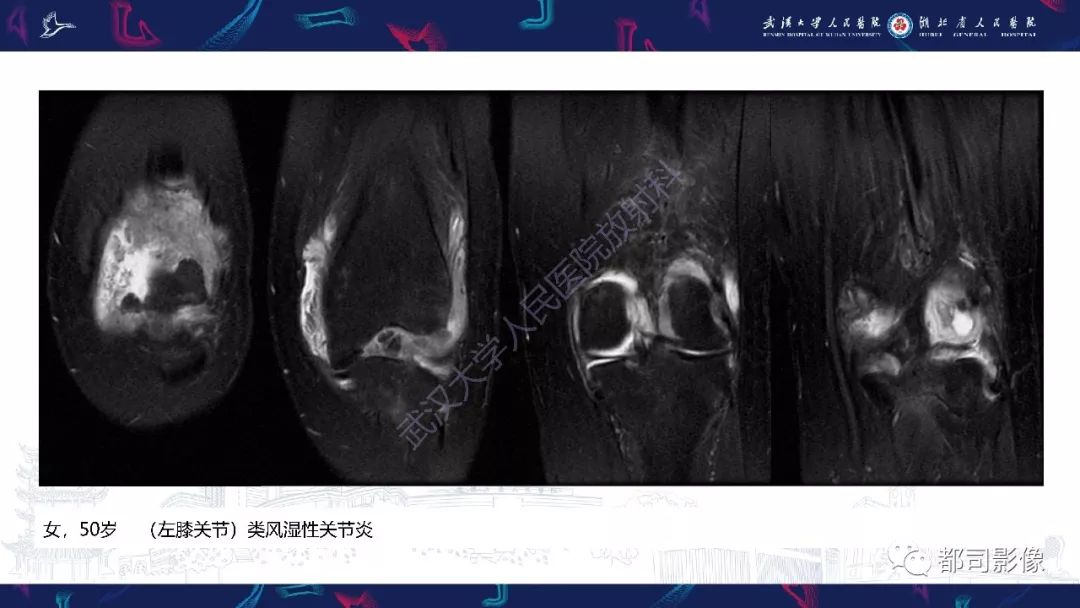 【PPT】关节滑膜弥漫性增厚病变影像诊断-12