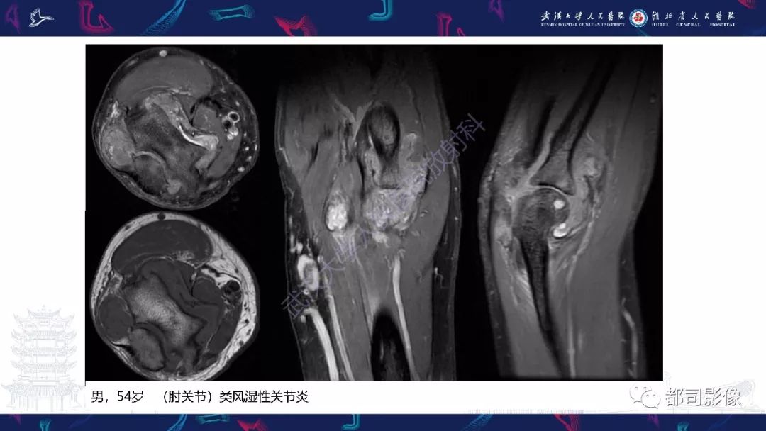 【PPT】关节滑膜弥漫性增厚病变影像诊断-13