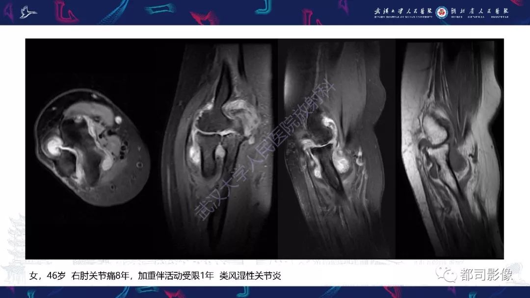 【PPT】关节滑膜弥漫性增厚病变影像诊断-14