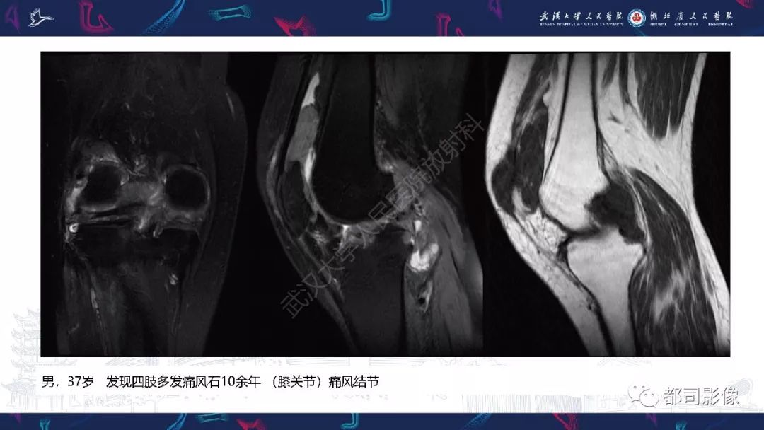 【PPT】关节滑膜弥漫性增厚病变影像诊断-17