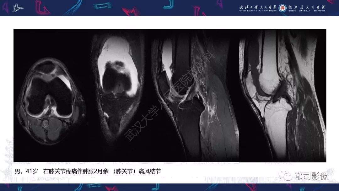 【PPT】关节滑膜弥漫性增厚病变影像诊断-18