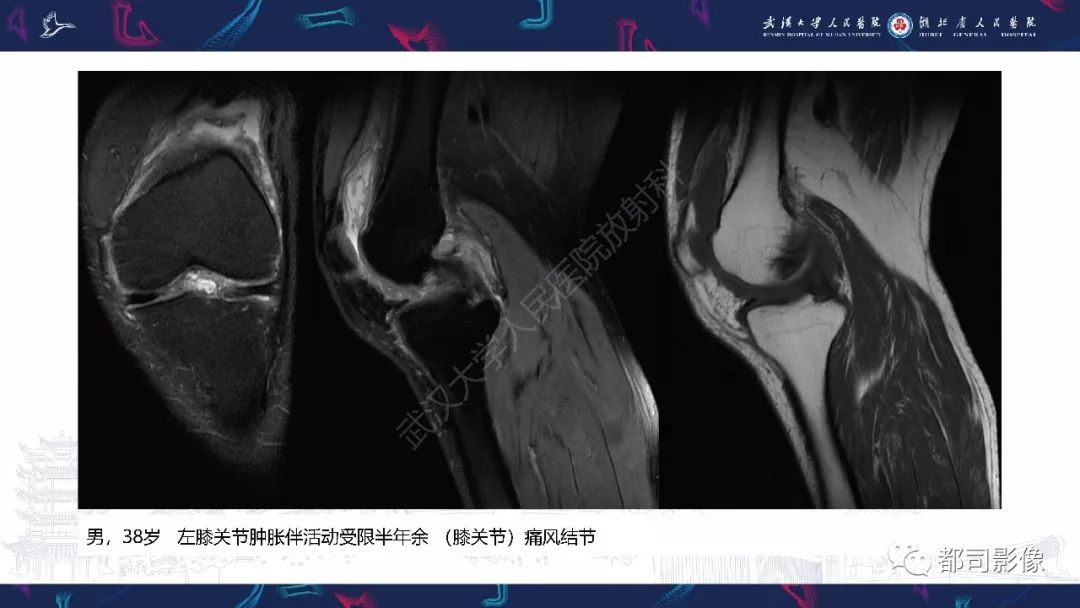 【PPT】关节滑膜弥漫性增厚病变影像诊断-19