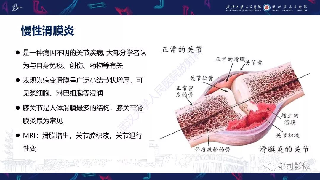 【PPT】关节滑膜弥漫性增厚病变影像诊断-20