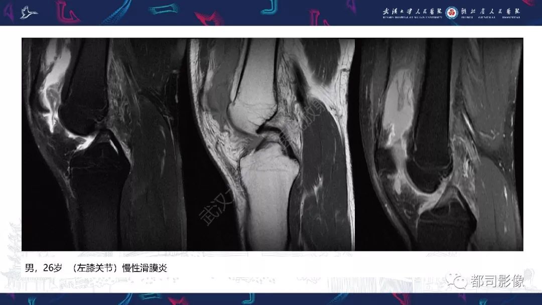 【PPT】关节滑膜弥漫性增厚病变影像诊断-21