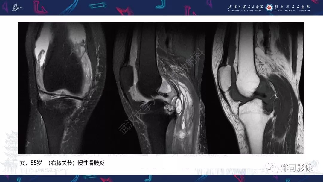 【PPT】关节滑膜弥漫性增厚病变影像诊断-22