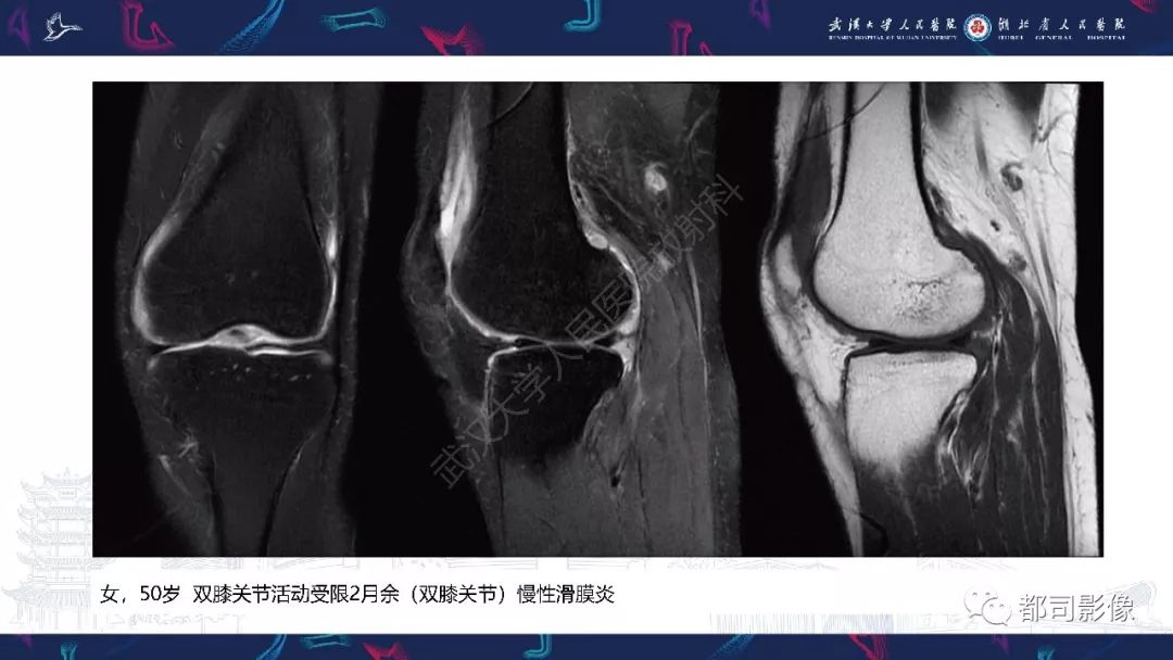 【PPT】关节滑膜弥漫性增厚病变影像诊断-23