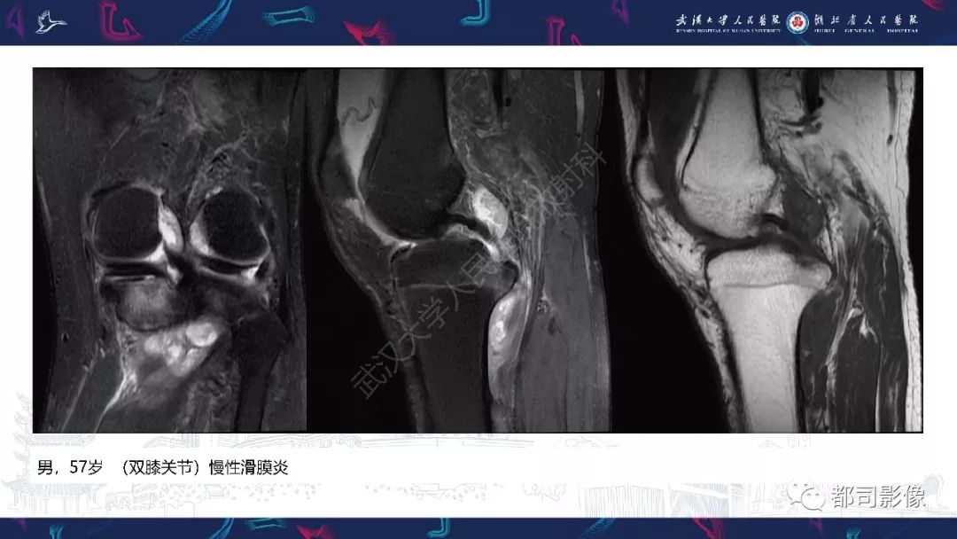 【PPT】关节滑膜弥漫性增厚病变影像诊断-24