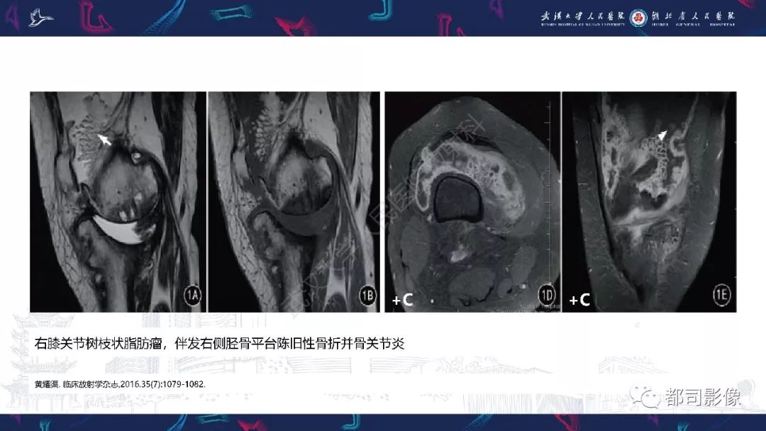 【PPT】关节滑膜弥漫性增厚病变影像诊断-26
