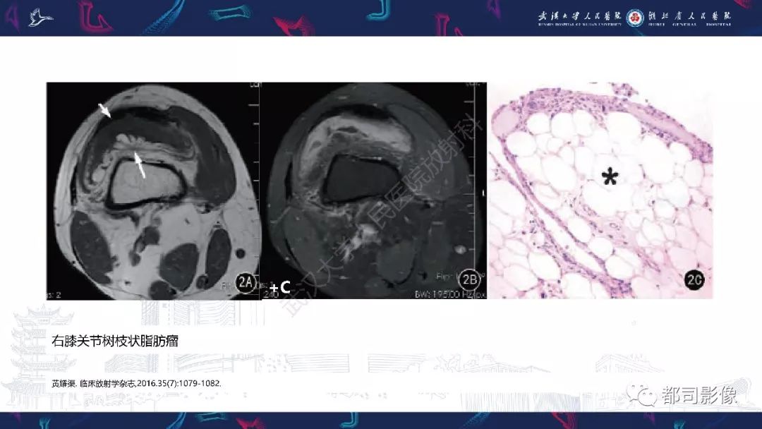 【PPT】关节滑膜弥漫性增厚病变影像诊断-27