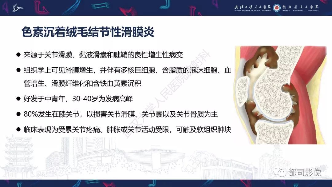 【PPT】关节滑膜弥漫性增厚病变影像诊断-28