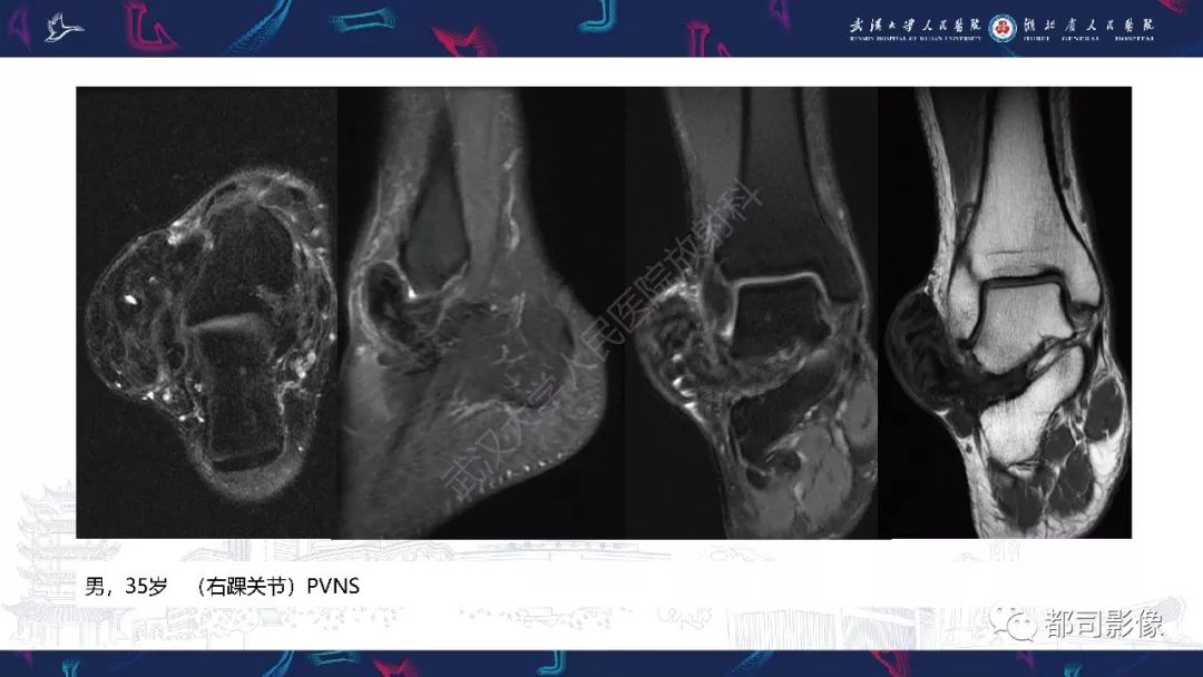 【PPT】关节滑膜弥漫性增厚病变影像诊断-30