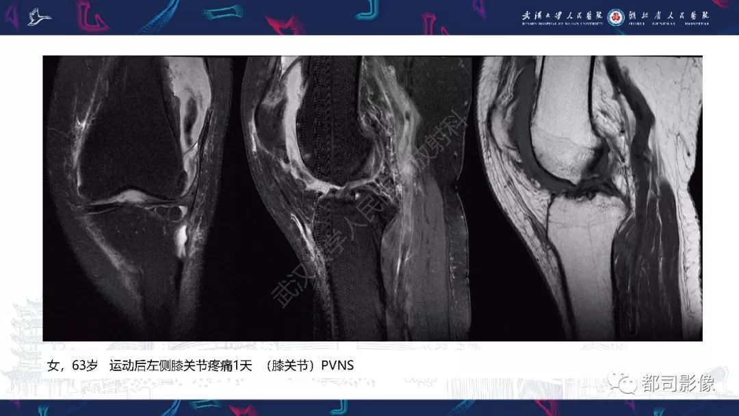 【PPT】关节滑膜弥漫性增厚病变影像诊断-31