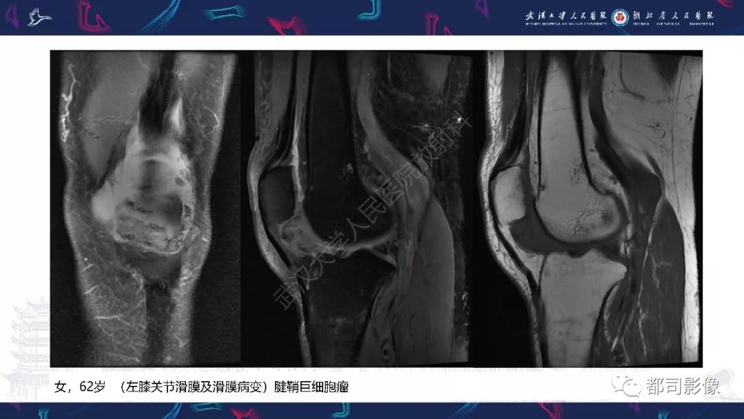 【PPT】关节滑膜弥漫性增厚病变影像诊断-34