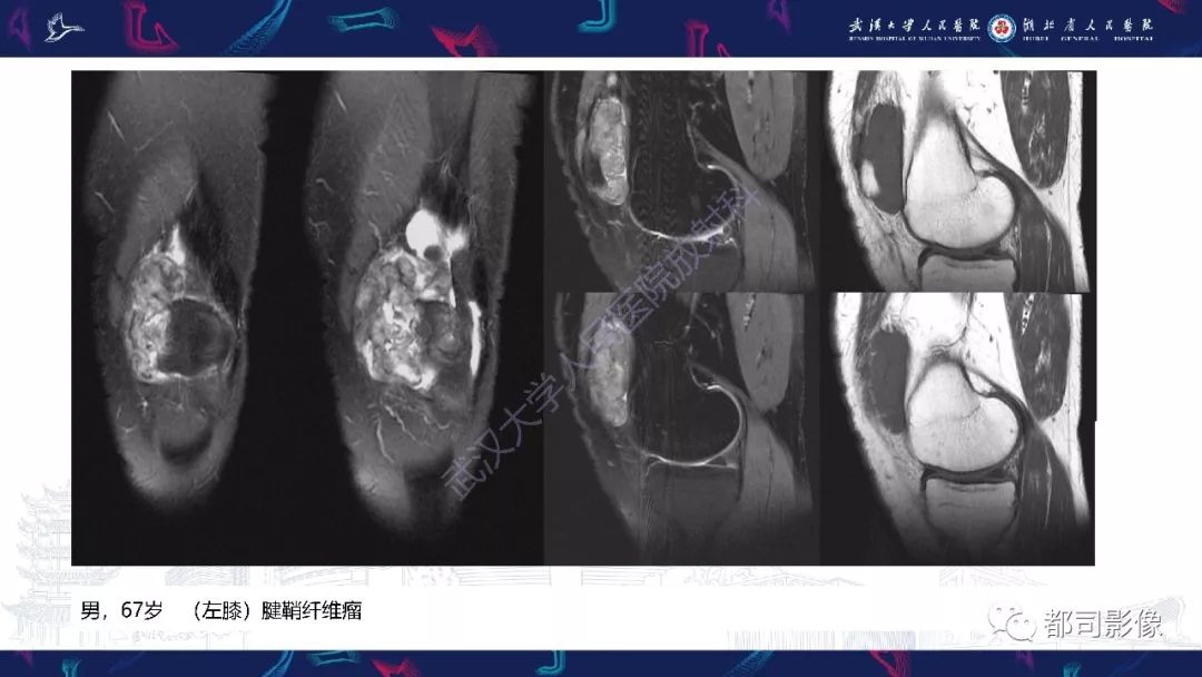 【PPT】关节滑膜弥漫性增厚病变影像诊断-36
