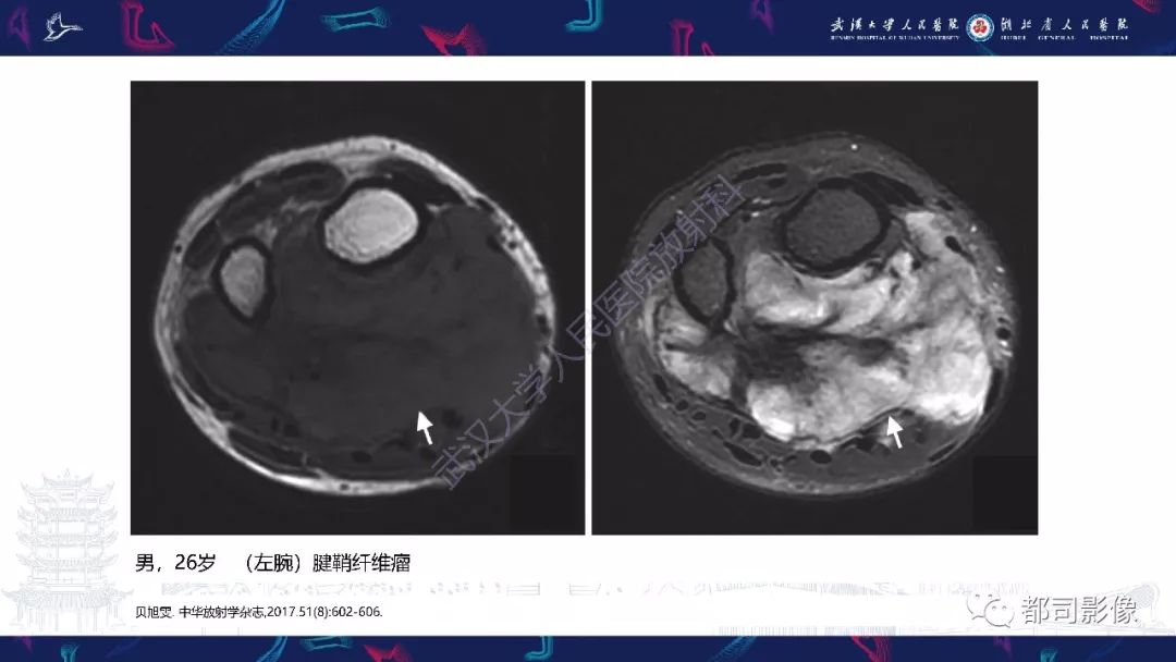 【PPT】关节滑膜弥漫性增厚病变影像诊断-37
