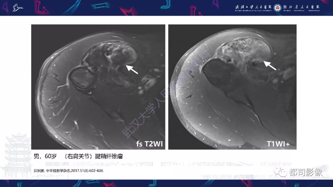 【PPT】关节滑膜弥漫性增厚病变影像诊断-38