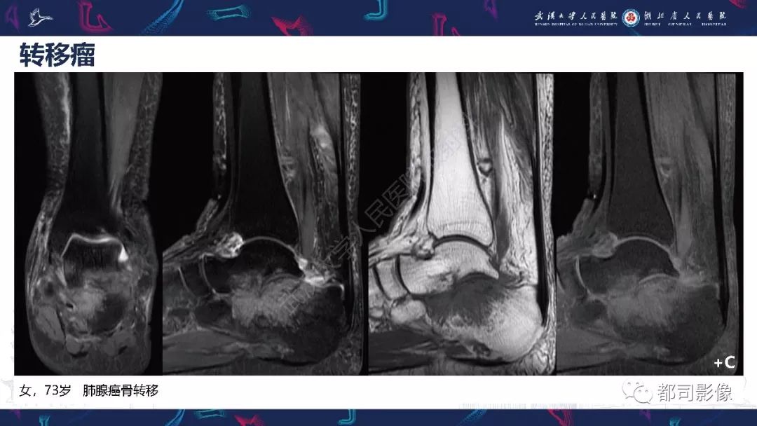 【PPT】关节滑膜弥漫性增厚病变影像诊断-39